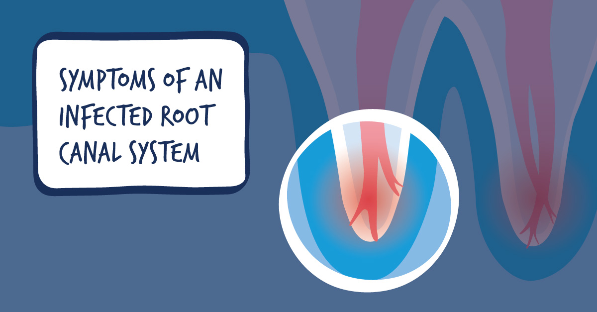 Do I need a root canal?