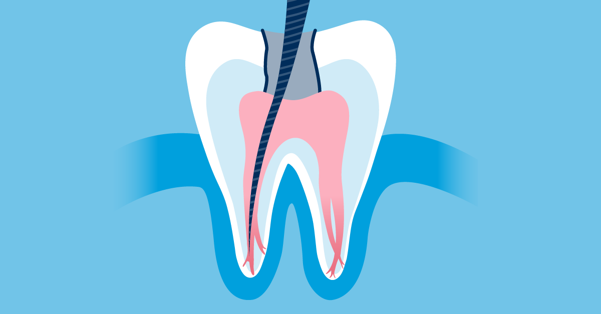 The History Of Root Canal Therapy