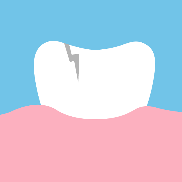 Root Canal Causes